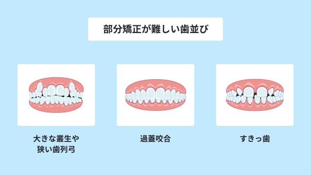 「すきっ歯」も部分矯正では治らない?