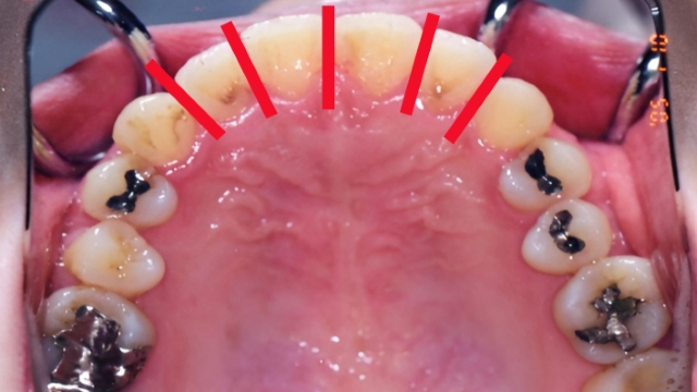 「歯を削る(IPR)」ことの不可逆的な代償