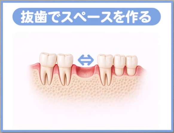 １．抜歯: 歯を抜くことで、強制的に大きなスペースを作る。