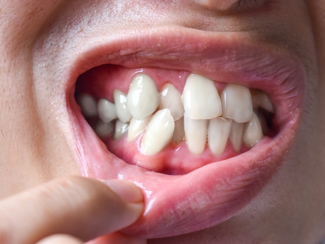 歯並びが悪くなる根本原因：スペース不足