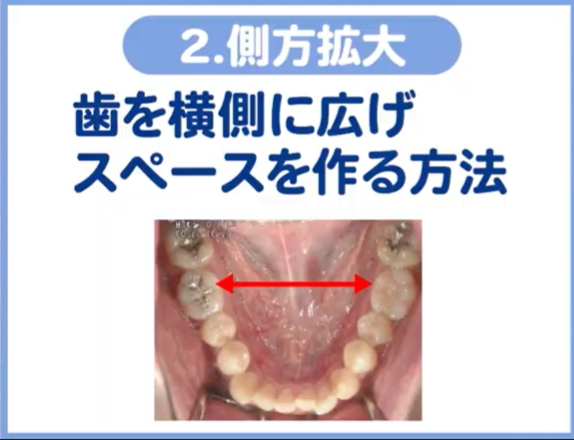 ２．拡大: 歯列が並んでいるアーチを外側に広げ、スペースを作る。