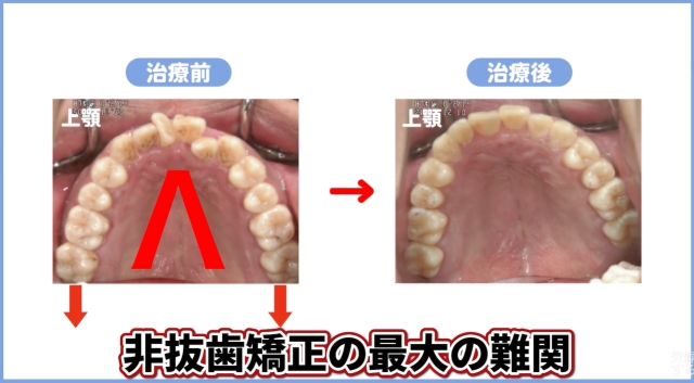 奥歯の遠心移動