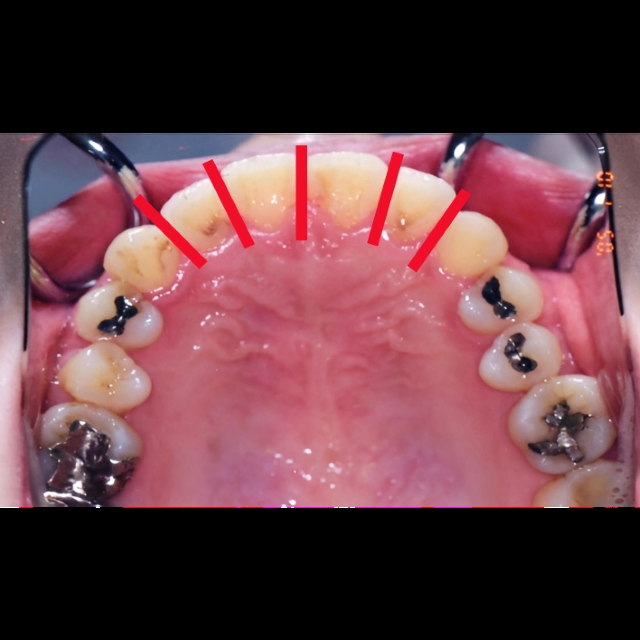 ４．隣接面削合（IPR）: 隣り合う歯の側面を少し削り、歯の幅を狭くする。