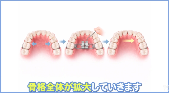 抜かない矯正の適応条件：年齢による決定的な違い