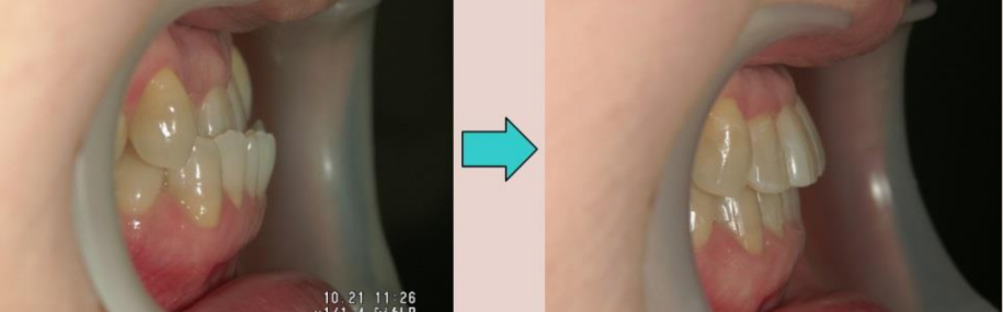 骨格的な受け口・出っ歯1