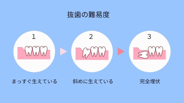 抜歯の難易度と痛みについて:心構えのために