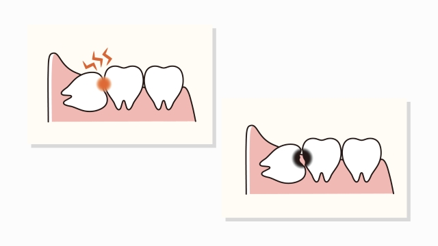 手前の「大黒柱(7番目の歯)」を破壊する(最大のリスク)