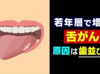 20年で倍増…増える若年層の「舌がん」 現代人特有の “狭い歯並び” が引き金に? 口内炎との決定的な違いとは